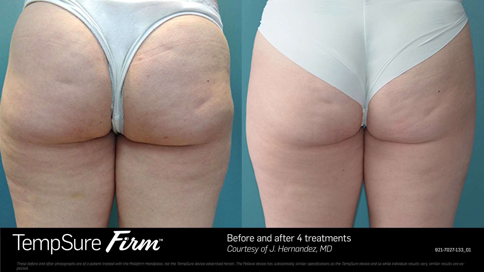 Buttocks and thigh skin tightening before and after