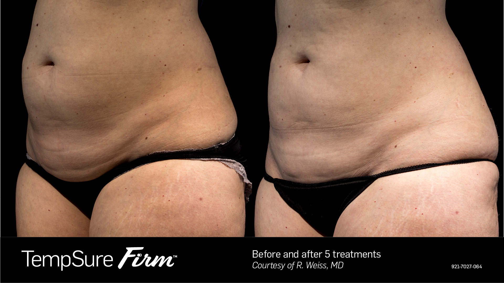 Waist skin tightening before and after