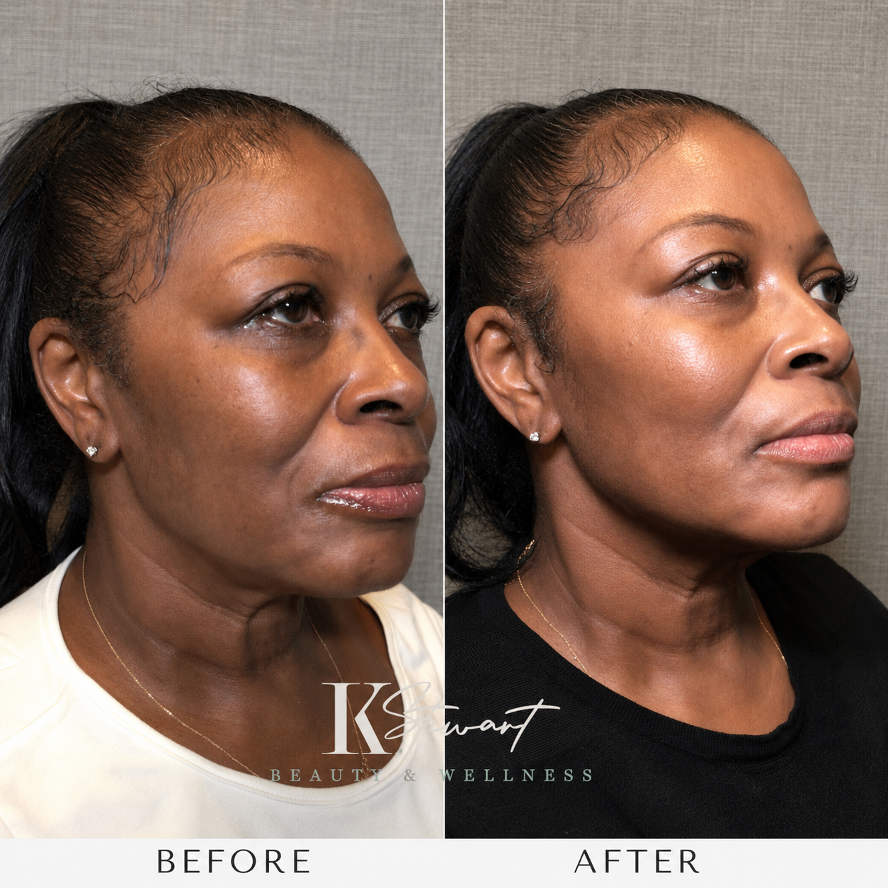 Facial balancing before and after results in Baltimore, MD