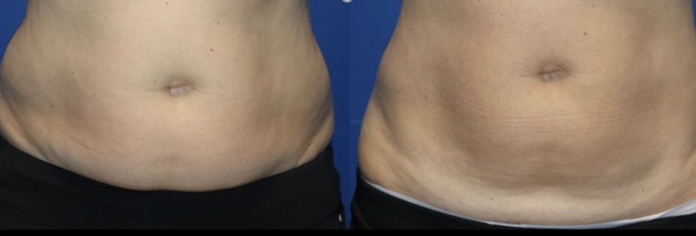 Midsection skin tightening before and after