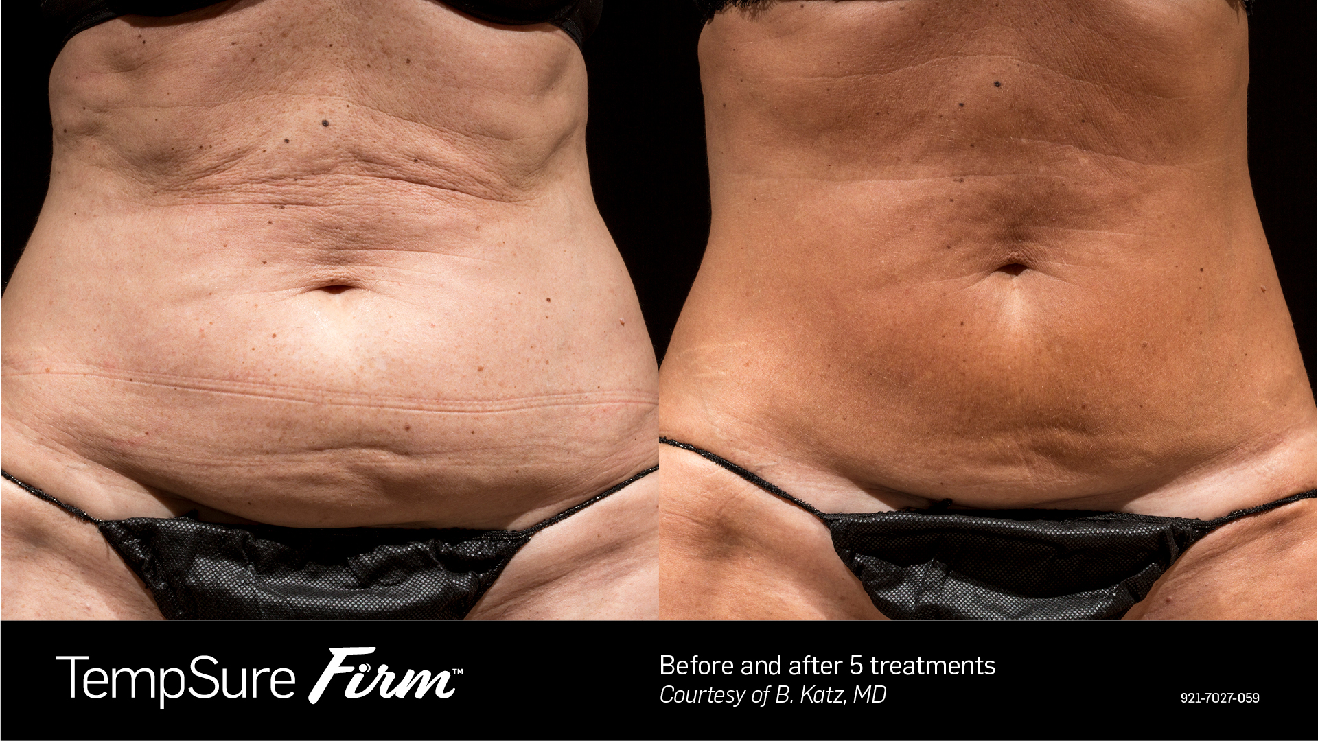 Abdomen skin tightening before and after