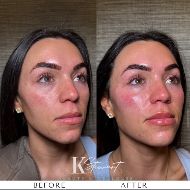 Facial balancing before and after results in Baltimore, MD