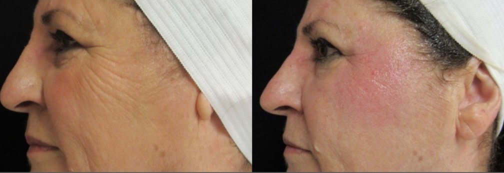 Facial skin tightening before and after