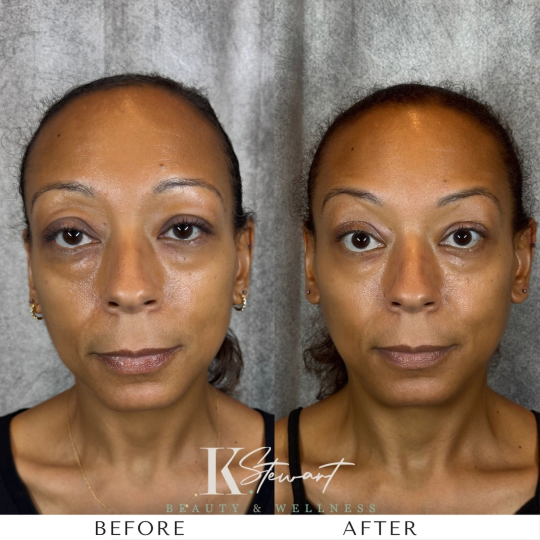 Under eye and facial refresh before and after result