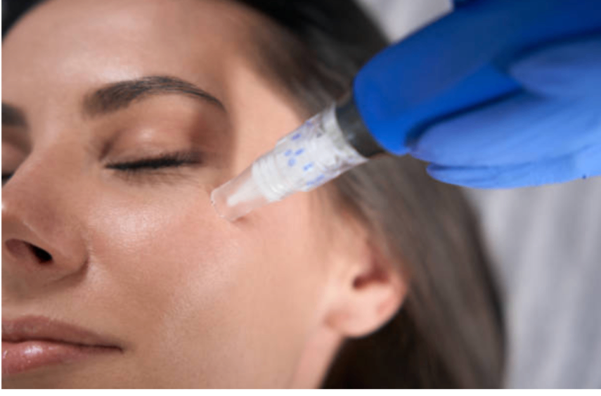 Close-up of a microneedling treatment being performed near the eye area