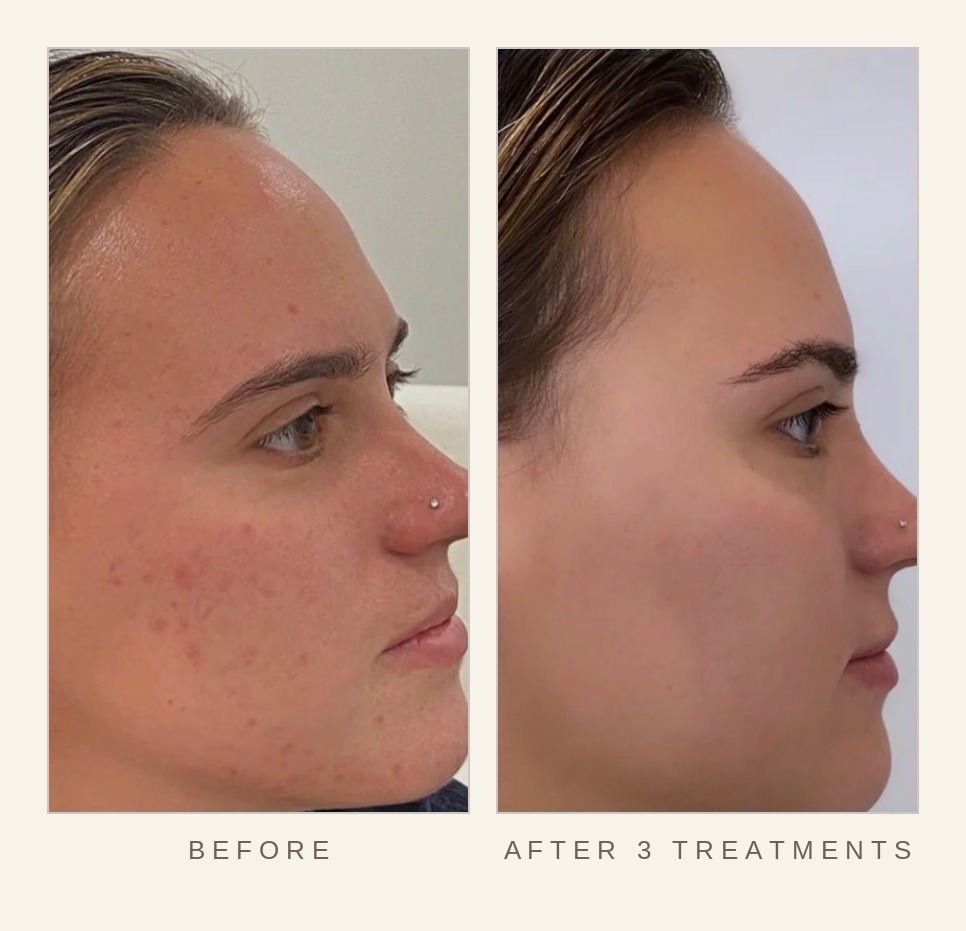 Microneedling before and after three treatments, showing clearer, smoother skin