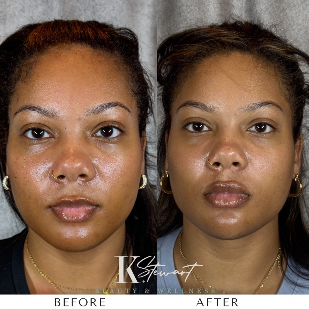 Facial rejuvenation before and after result