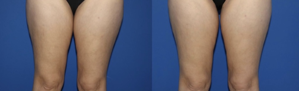 Thigh skin tightening before and after