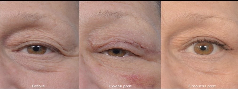 Eye area skin tightening before and after