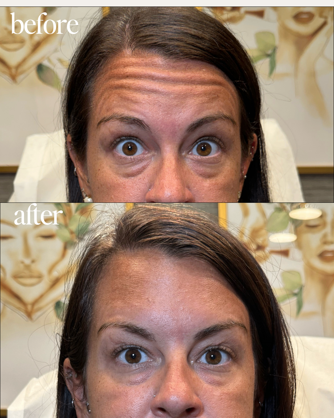 Forehead line smoothing before and after