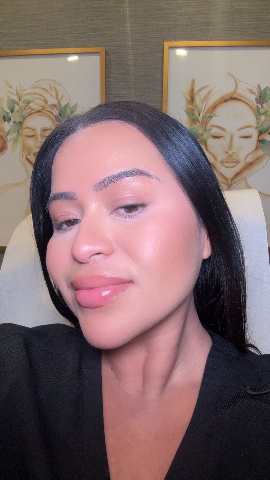 Client with naturally enhanced lips and refined features after injectables