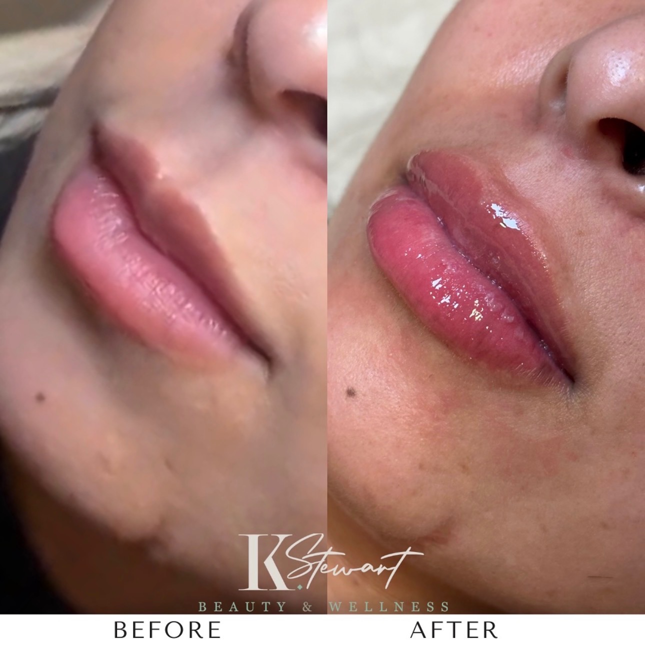 Lip enhancement before and after