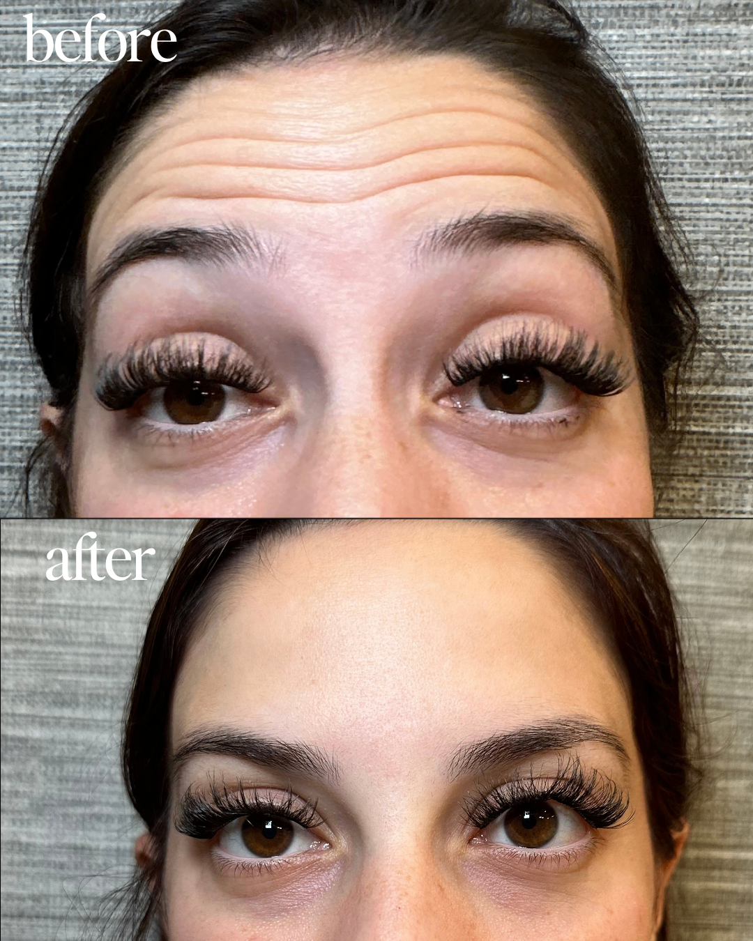 Before and after brow and forehead refinement result