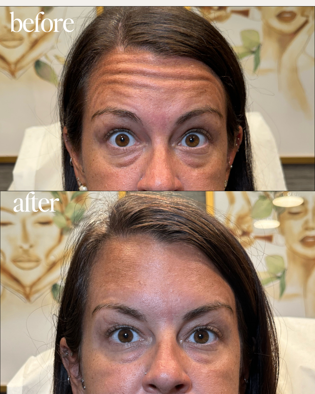 Before and after frown line treatment result