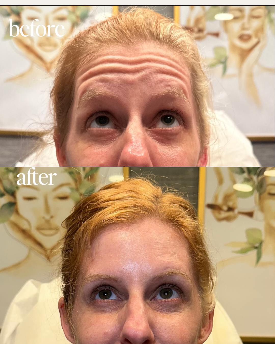 Before and after forehead line smoothing result