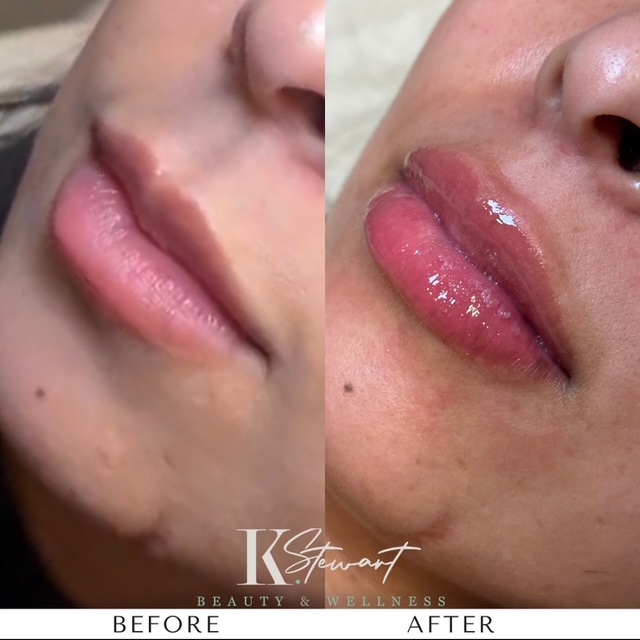 Before and after lip enhancement result