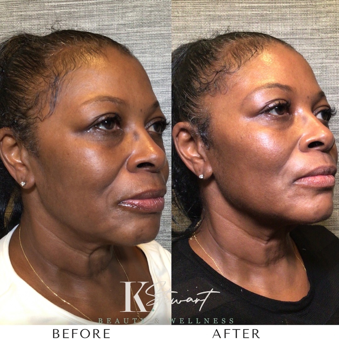 Facial lift and contour before and after
