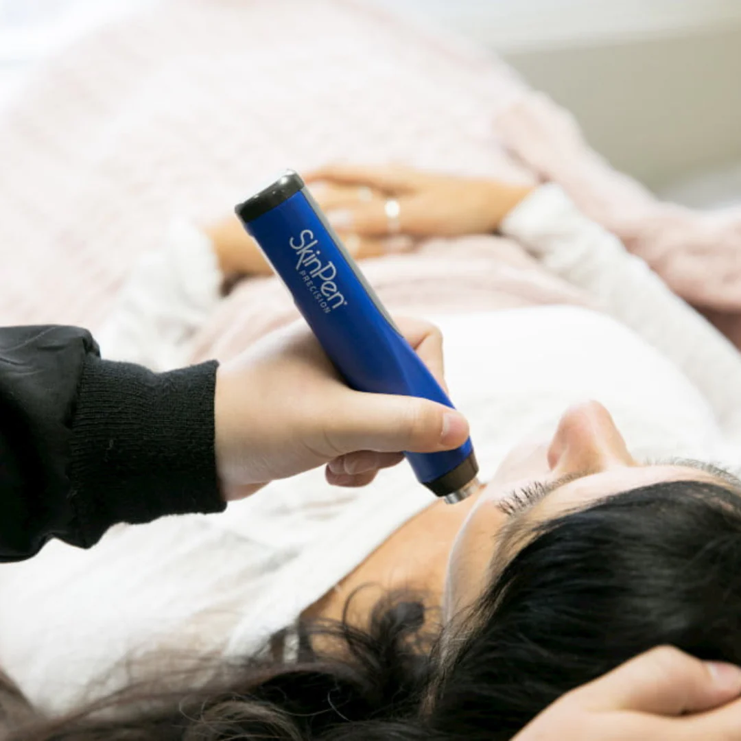 Model getting Microneedling